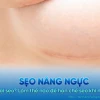 Nâng ngực có để lại sẹo không những yếu tố cần biết