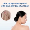 Nguyên nhân nổi mụn lưng và cách khắc phục hiệu quả