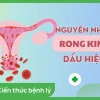 Rong Kinh Là Gì? Nguyên Nhân, Dấu Hiệu Và Cách Điều Trị Hiệu Quả Năm 2026