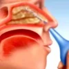 Rửa mũi bị đau tai ở người lớn: Nguyên nhân, cách xử lý và phòng ngừa