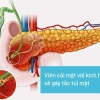 Sỏi mật là gì? Nguyên nhân, dấu hiệu nhận biết và cách điều trị hiệu quả