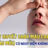 Sốt Xuất Huyết Chảy Máu Mũi: Dấu Hiệu Nguy Hiểm Cần Nhận Biết