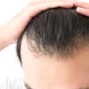 Tóc bò liếm là gì và cách khắc phục hiệu quả tại nhà