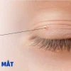 Trị mụn thịt quanh mắt: Nguyên nhân, cách điều trị và phòng ngừa hiệu quả