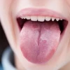 Tưa lưỡi là gì? Nguyên nhân, dấu hiệu nhận biết và cách điều trị hiệu quả