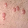 U nhú sinh dục là gì? Phân biệt lành tính và ác tính, phương pháp điều trị