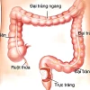 Viêm đại tràng: Nguyên nhân, triệu chứng và cách điều trị hiệu quả
