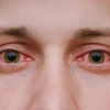 Viêm kết mạc mắt có nguy hiểm không? Nguyên nhân, triệu chứng và cách điều trị