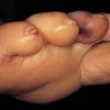 Viêm nội tâm mạc là gì? Triệu chứng, nguyên nhân và cách phòng ngừa