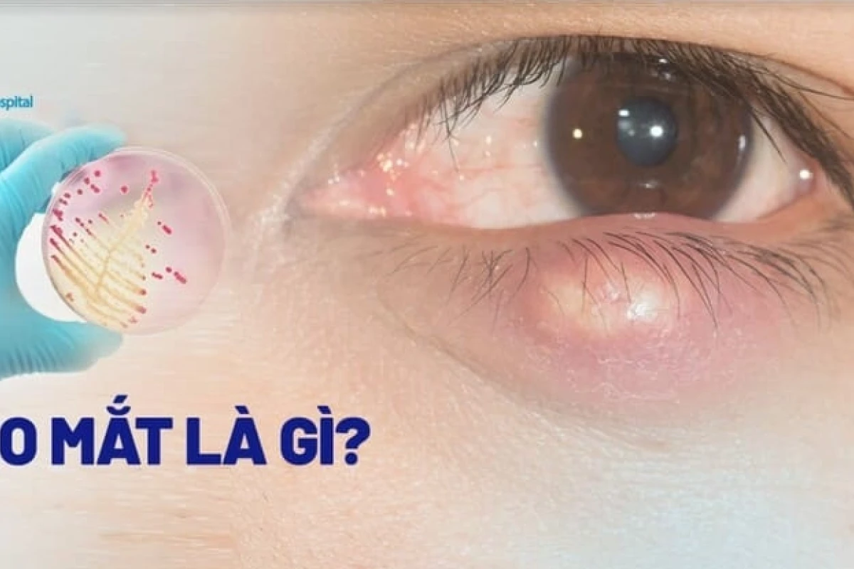 Bị nổi lẹo mắt: Nguyên nhân, dấu hiệu và cách xử lý hiệu quả