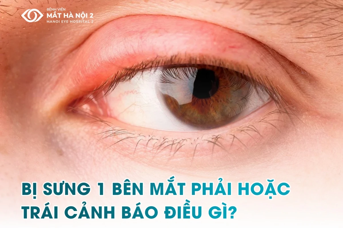 Bọng mắt bị sưng một bên: Nguyên nhân, dấu hiệu và cách khắc phục hiệu quả