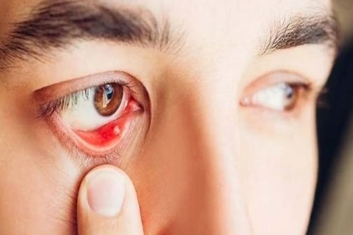Sạn vôi trong mắt: Chi phí lấy sạn vôi và các phương pháp điều trị