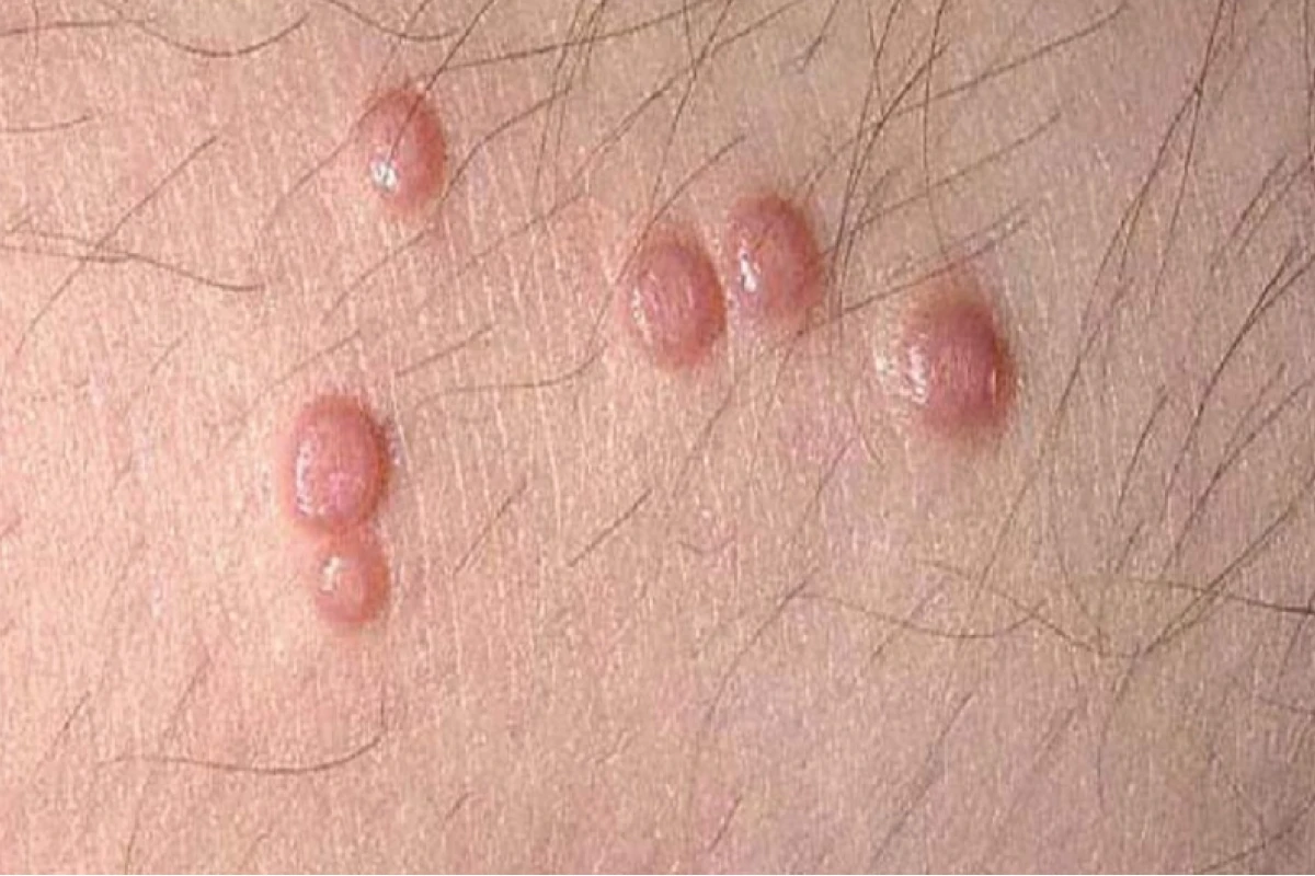 U nhú sinh dục là gì? Phân biệt lành tính và ác tính, phương pháp điều trị