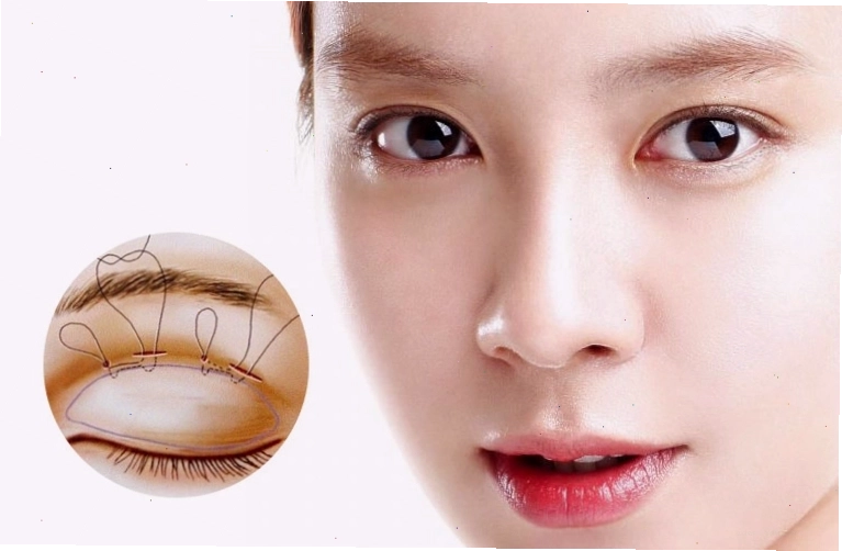Bấm mí mắt giúp mắt to tròn và đẹp