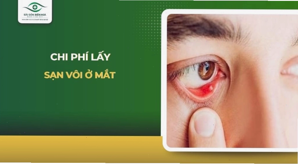 Bảng giá tham khảo chi phí lấy sạn vôi mắt
