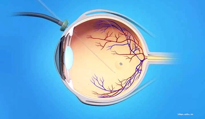Bệnh lỗ hoàng điểm và cách điều trị