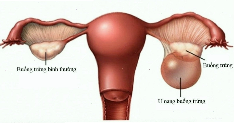 Biến chứng có thể xảy ra khi nâng ngực bằng mỡ tự thân
