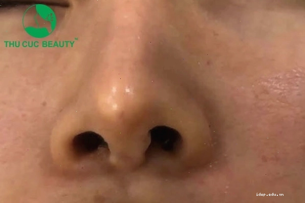 Các dấu hiệu nhận biết nâng mũi bị tụt sụn