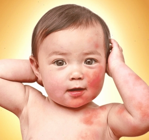 Các nốt đỏ trên da có thể nhầm lẫn với bệnh Lyme