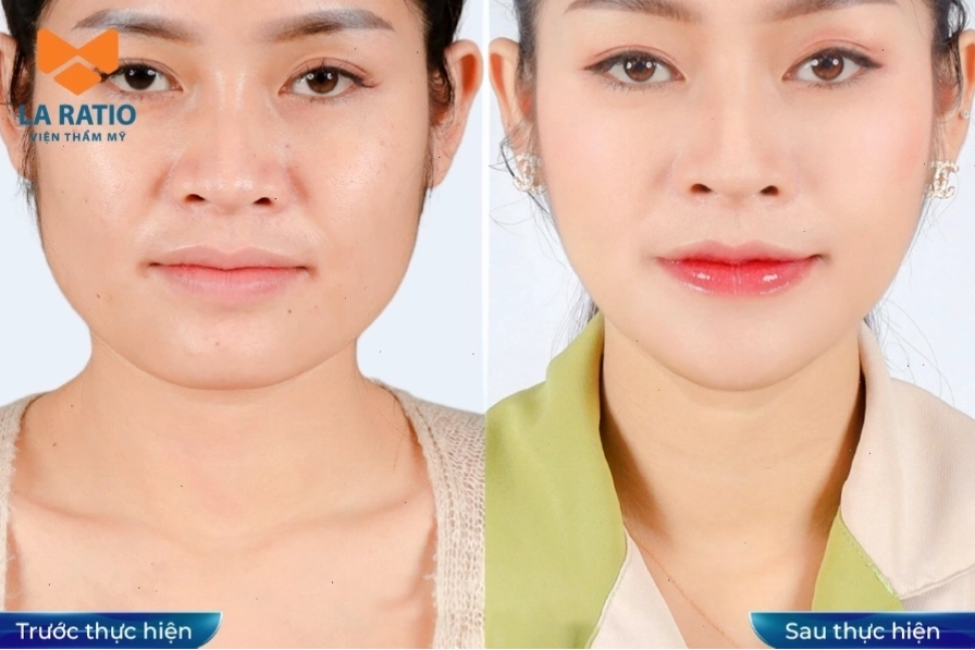 Các phương pháp chỉnh sửa mũi củ tỏi hiệu quả