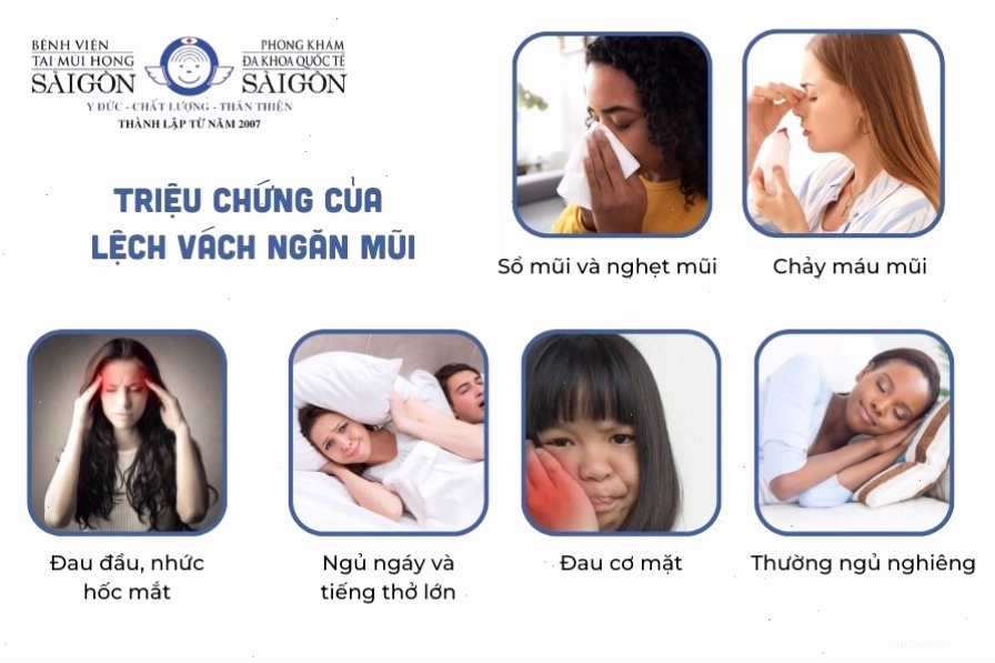 Các triệu chứng của lệch vách ngăn mũi