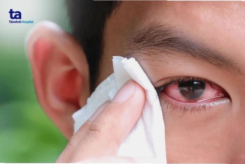 Các triệu chứng phổ biến của viêm kết mạc mắt