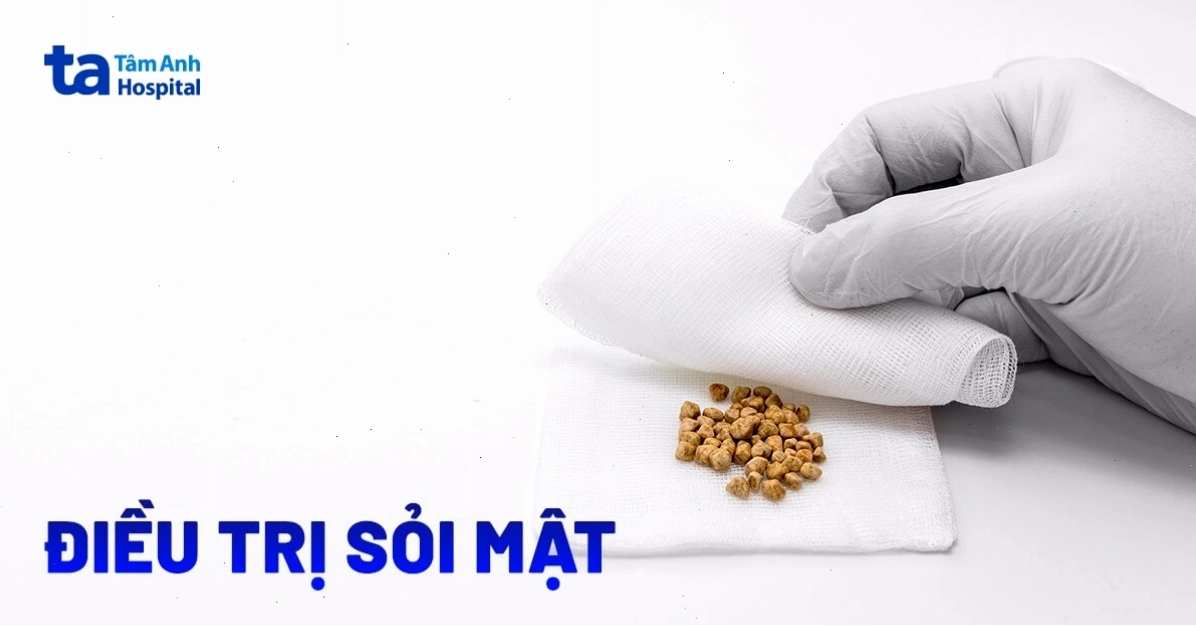Cách điều trị sỏi mật hiệu quả – Bệnh có chữa tại nhà được không?
