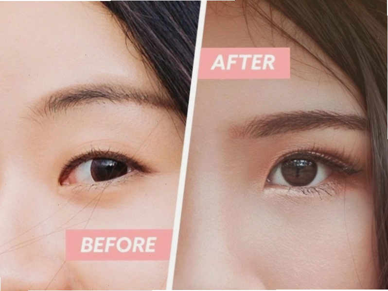 Cải thiện mắt một mí bằng tiểu phẫu