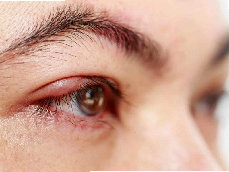 Cải thiện tình trạng mắt sưng khi ngủ dậy bằng các biện pháp tự nhiên