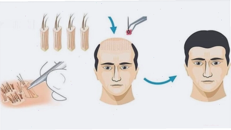 Cấy tóc tự thân giúp phân bố lại mật độ tóc