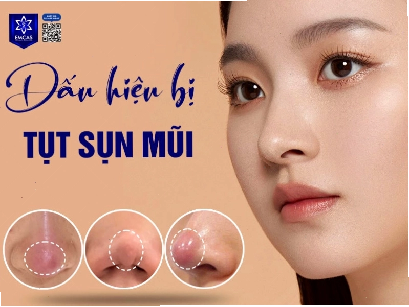 Chăm sóc sau khi chỉnh sửa mũi bị tụt