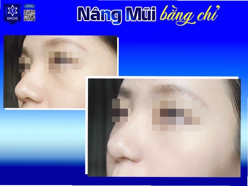 Chăm sóc sau nâng mũi bằng chỉ là bước quan trọng