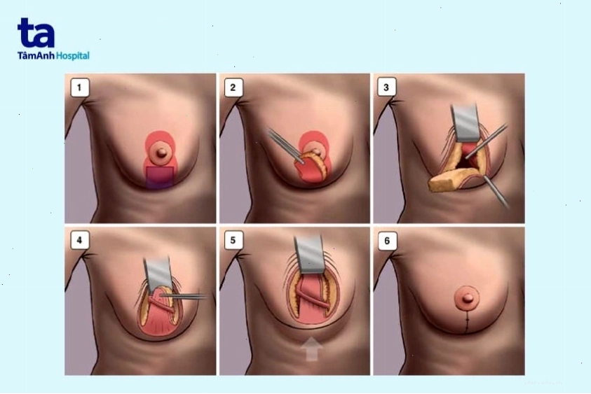 Chăm sóc vết mổ sau phẫu thuật nâng ngực