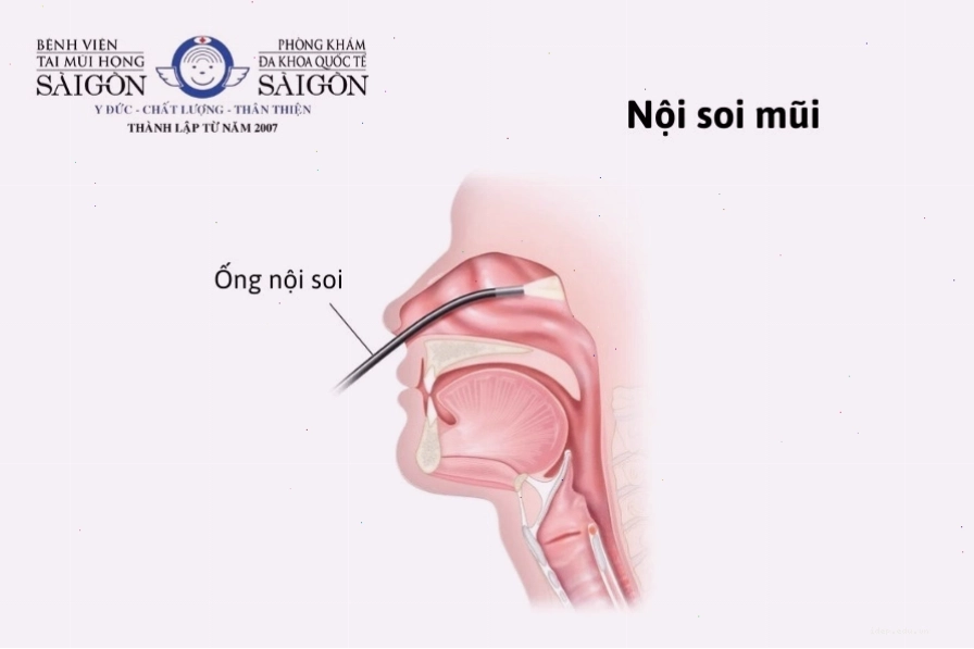 Chẩn đoán lệch vách ngăn mũi bằng nội soi