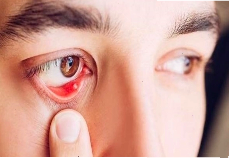 Có thể dễ dàng phát hiện sạn vôi ở mắt bằng mắt thường hoặc qua thăm khám