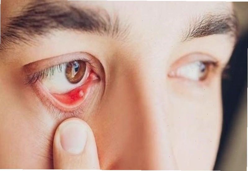 Có thể dễ dàng phát hiện sạn vôi ở mắt qua thăm khám