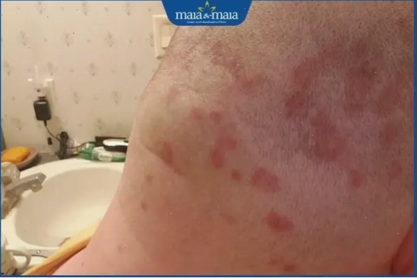Da đầu bị ngứa sau khi cạo