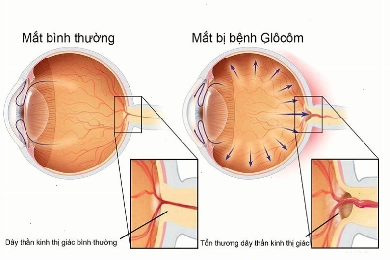 Đau hốc mắt là gì và có nguy hiểm không