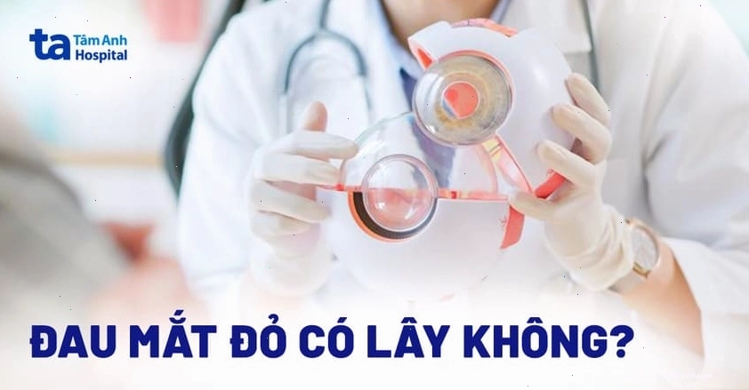 Đau mắt đỏ có thể lây lan qua tiếp xúc trực tiếp hoặc gián tiếp