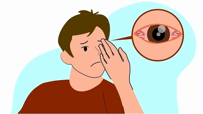 Dược sĩ tư vấn về các loại thuốc nhỏ mắt trị viêm giác mạc