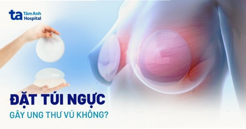 Giải đáp thắc mắc đặt túi ngực có gây ung thư vú không