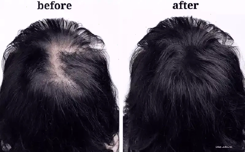 Giảm căng thẳng để cải thiện tình trạng rụng tóc