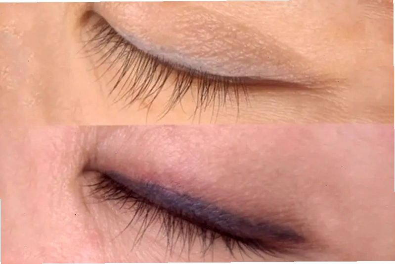 Hình ảnh cải thiện rõ rệt sau liệu trình xóa xăm mí