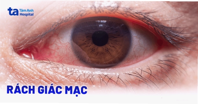 Hình ảnh giác mạc sau phẫu thuật ghép