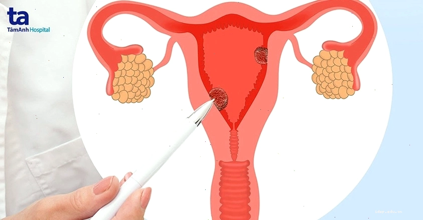 Hình ảnh minh họa buồng trứng đa nang với nhiều nang nhỏ