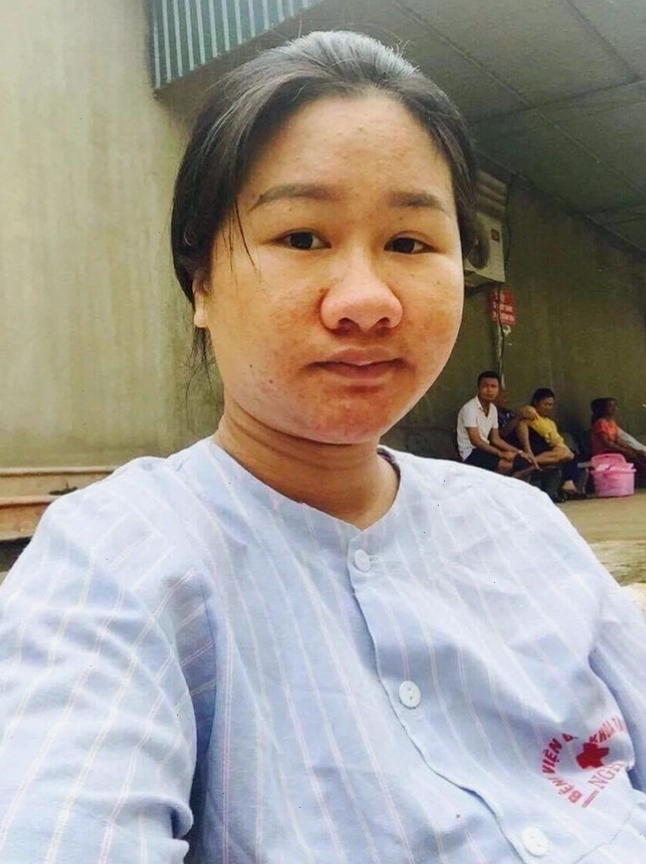 Hình ảnh minh họa mũi nở to do thay đổi hormone khi mang thai