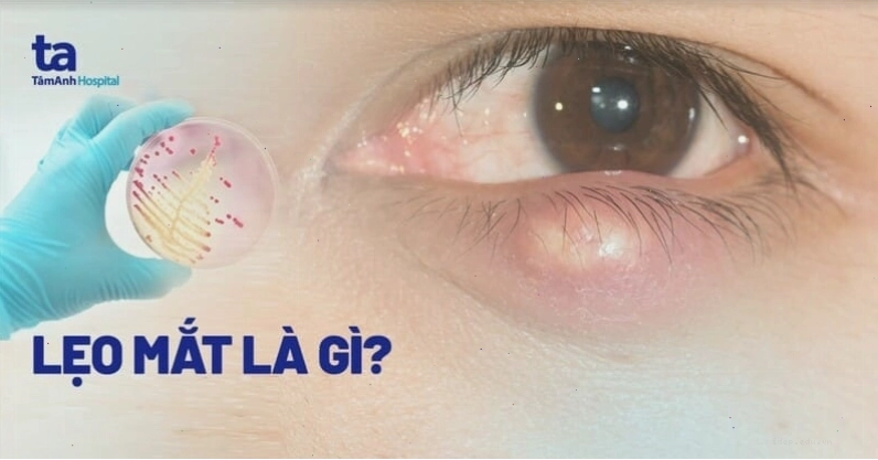 Hình ảnh minh họa mụt lẹo mắt gây sưng đỏ