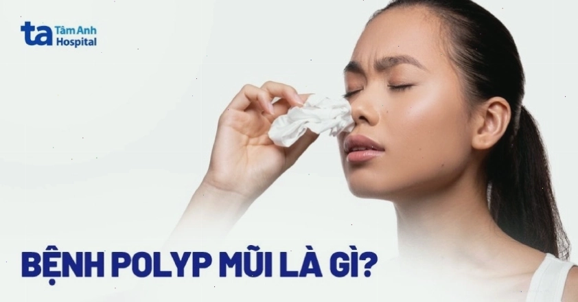 Hình ảnh minh họa polyp mũi