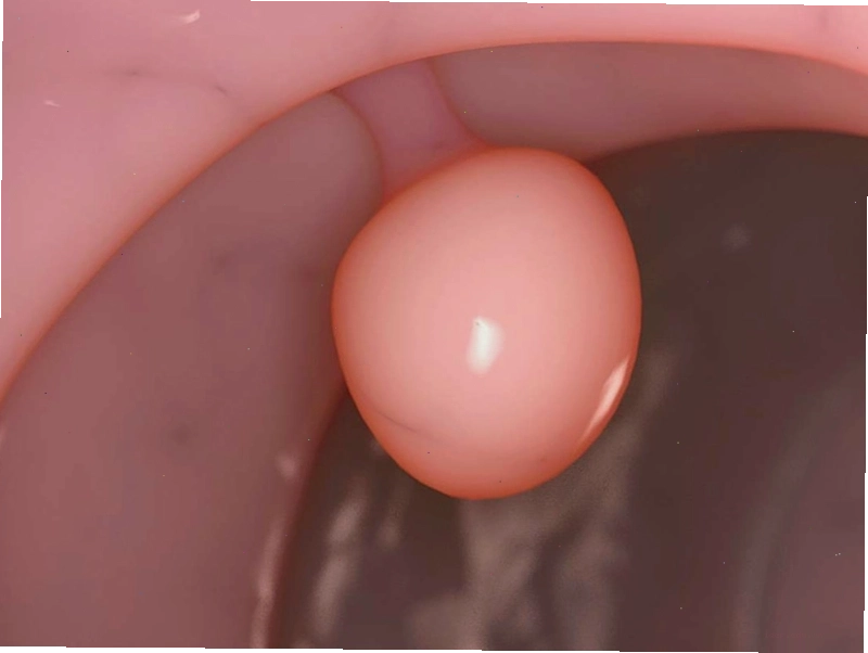 Hình ảnh minh họa polyp tử cung gây rong kinh