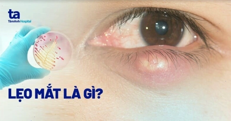 Hình ảnh minh họa tình trạng bị nổi lẹo mắt